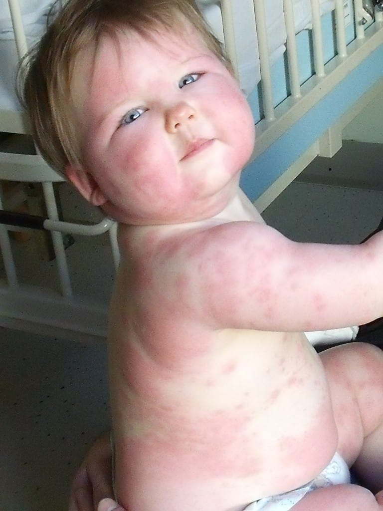 Baby swelling body... possible allergic reaction amoxicillin?
