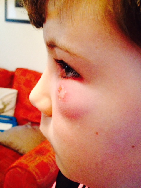 cold sore on eyelid side view